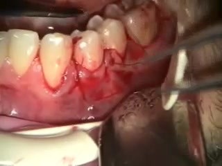 Covering Recession Caused By Root Resorption
