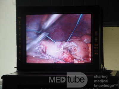Gastric Ulcerated Adenocarcinoma of the Pre-pyloric Antrum (12 of 28)