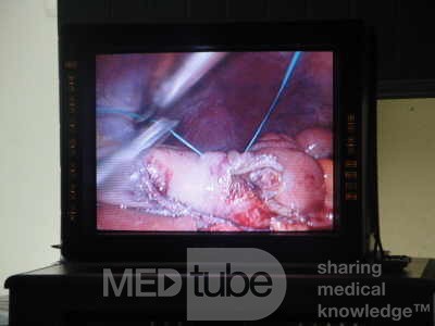 Gastric Ulcerated Adenocarcinoma of the Pre-pyloric Antrum (12 of 28)