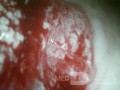 Cervical adenocarcinoma (carcinoma glandulare colli uteri)
