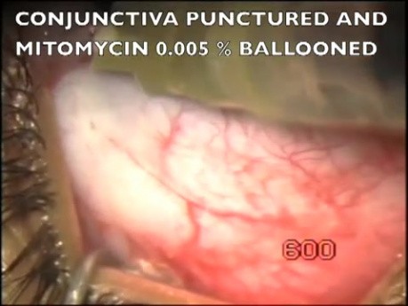 Microtrack filtration in buphthalmos