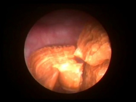 Urinary Bladder Stones