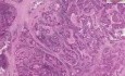 Adenocarcinoma, metastatic - Histopathology - Lymph node