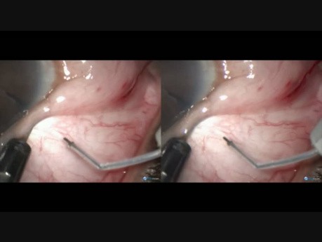 Congenital Abnormality in Iris - Glaucoma - MTF
