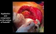 TachoSil for Sufficient Haemostasis and Sealing in a Double Lung Transplantation with V-V ECMO
