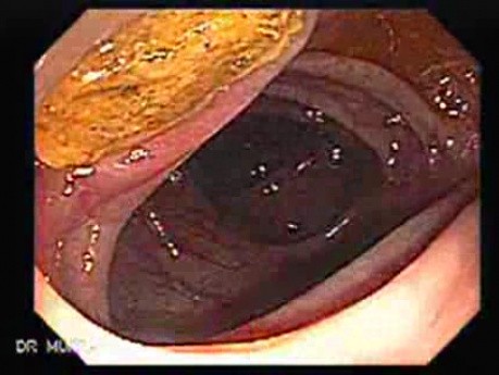 Colon Diverticulum - Endoscopy (2 of 3)