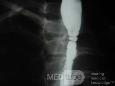 Congenital Esophageal Rings (4 of 5)