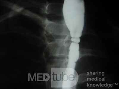 Congenital Esophageal Rings (4 of 5)