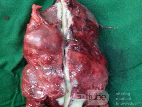 Spleen Tuberculosis 