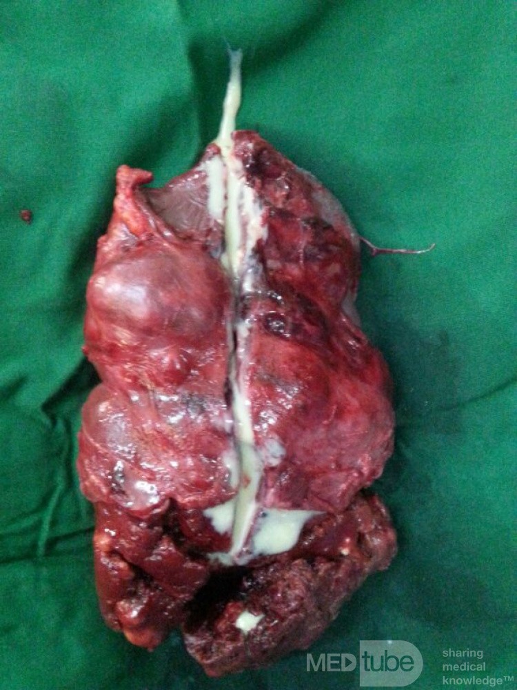 Spleen Tuberculosis 