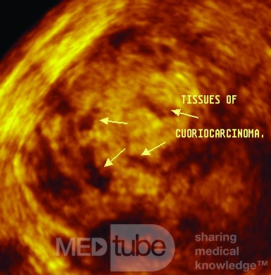 choriocarcinoma by 3dus