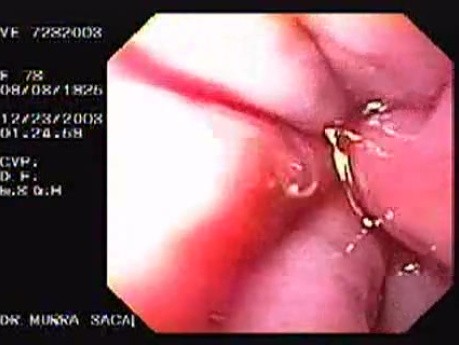 Hemorrhage due status post rubber band ligation of esophageal varices (22 of 25)