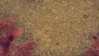 Bacterial vaginosis - Pap smear - 2