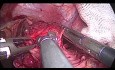 Laparoscopic Heller Cardiomyotomy with Dor Fundoplication