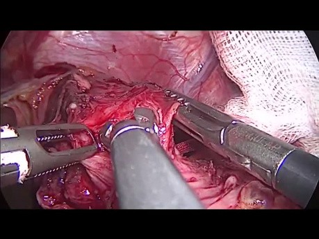 Laparoscopic Heller Cardiomyotomy with Dor Fundoplication