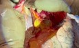 Harvesting a Lung with Anomalous Pulmonary Vein Drainage