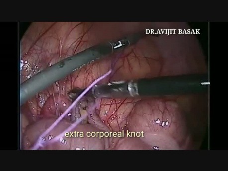 Laparoscopic Appendicectomy in Pregnancy