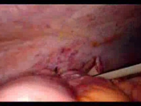 Colonic Perforation With Peritonitis - Laparoscopy (45 of 46)