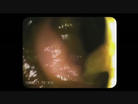 Colonoscopy Channel - Poor Quality Of Colon Preparation