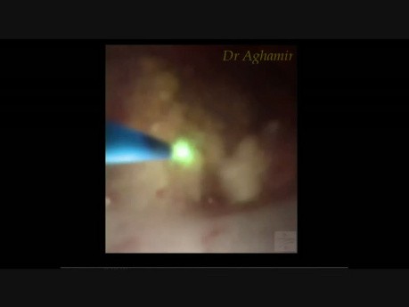 RIRS for Concomitant Renal Pelvis Stone and Tumor
