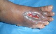 Diabetic foot ulcer with osteomyelitis