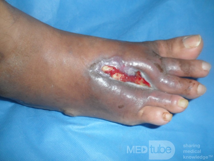 Diabetic foot ulcer with osteomyelitis