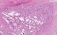 Prostate - Adenocarcinoma Gleason (grade 1) - Histopathology