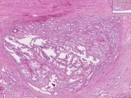 Prostate - Adenocarcinoma Gleason (grade 1) - Histopathology
