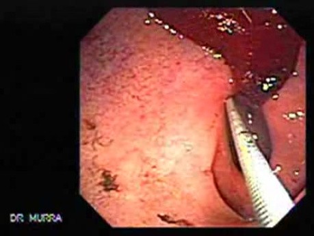 Duodenal Ulcer and Bleeding (4 of 23)