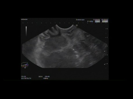 Endoscopic Ultrasound of Gastric GIST