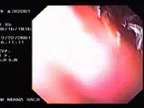 Duodenal Ulcers and Erosions (2 of 3)