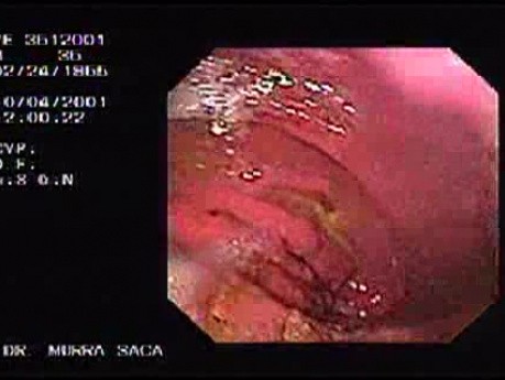 Hereditary Diffuse Gastric Cancer (HDGC) - Endoscopy (2 of 4)