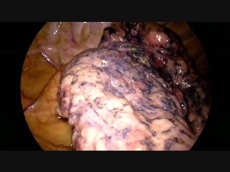 Non Edited Uniportal Vats Left Upper Anterior Segmentectomy S3 (Live Surgery From Catania in Hd 4k)