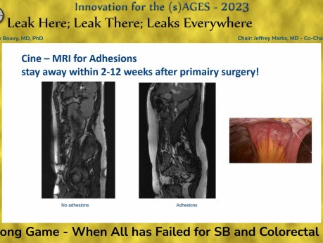 The Long Game - When All has Failed for SB and Colorectal Leaks - Nicole Bouvy