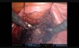 Robotic Prostatectomy with Retzius Preservation