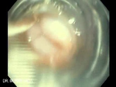 Upper GI bleeding due to Esophageal Varices - View Through Opaque Cylinder