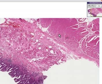 Barrett Esophagus 2