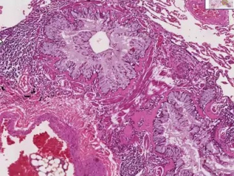 Asthma - Histopathology - Lung