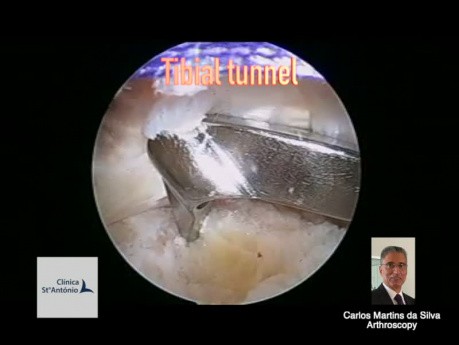 ACL Revision, Bone-Tendon-Bone