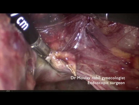 Complex Hysterectomy (Huge Uterus, Previous C Scar Sections)