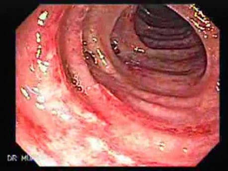Diverticular Colitis (1 of 7)