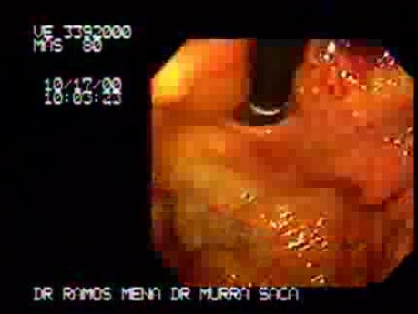 Adenocarcinoma of the Corpus and Fundus