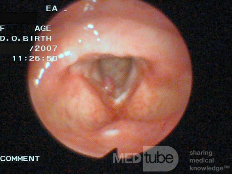 Vocal Fold Polyp