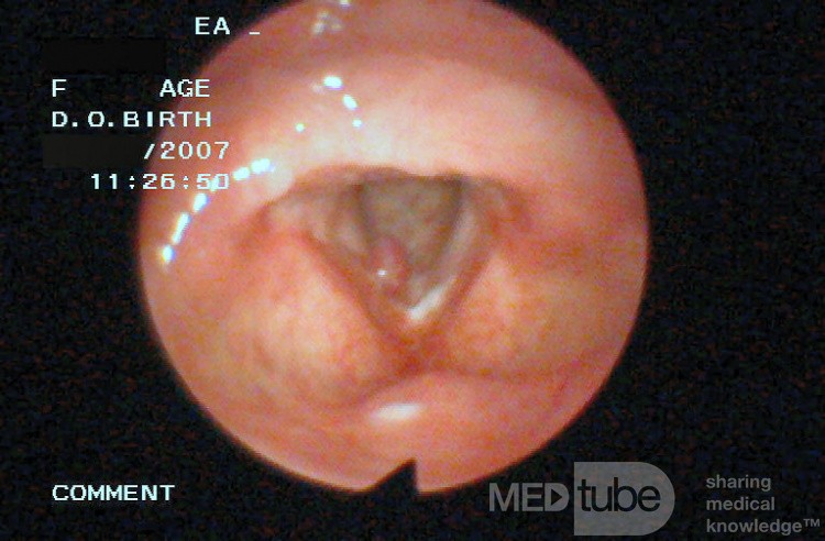 Vocal Fold Polyp