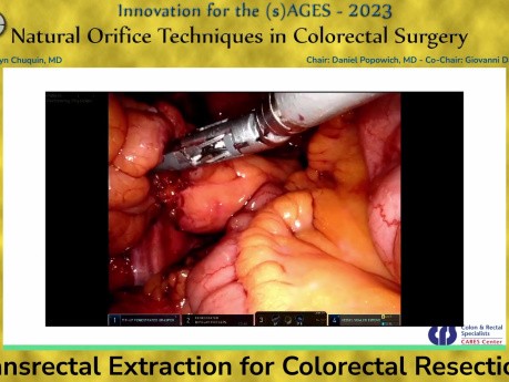 Transrectal Extraction for Colorectal Resections