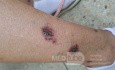 Vasculite? [3/6]