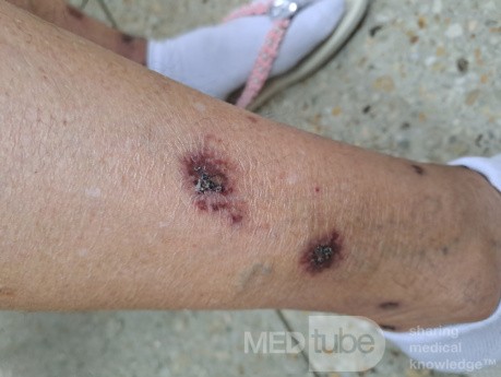 Vasculite? [3/6]