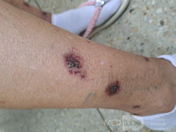 Vasculite? [3/6]