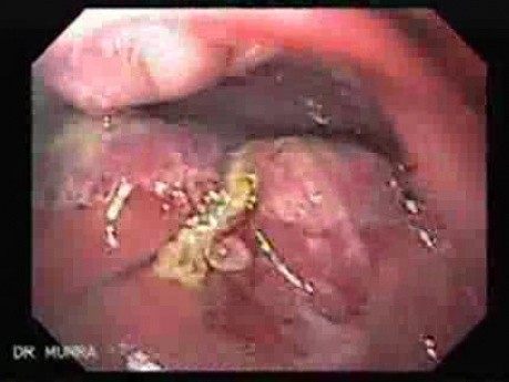 Recurrent Gastric Adenocarcinoma - Endoscopy (1 of 4)