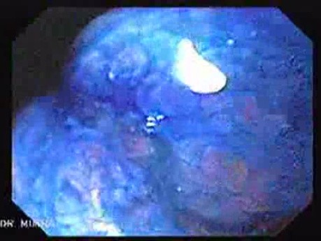 Gastric Polyp (6 of 7)